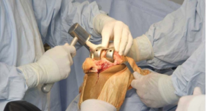 knee replacement surgery in Delhi